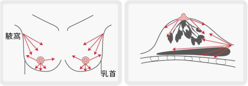 しこり　起きない　脂肪注入　方法