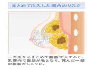 まとめて脂肪注入　リスク　図説