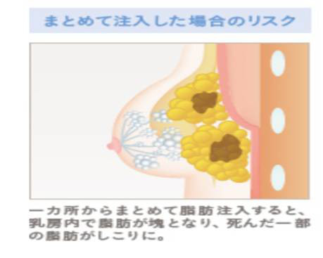 まとめて脂肪注入　リスク　図説