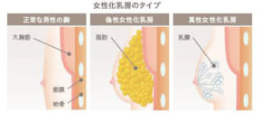 女性化乳房のタイプ　図説　画像