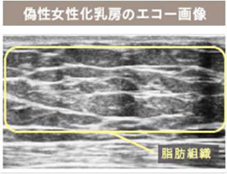 偽女性化乳房　エコー画像