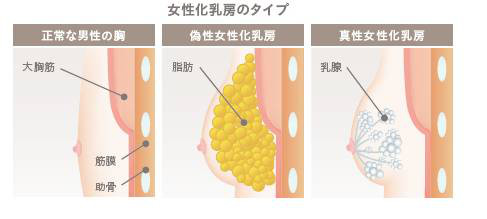 女性化乳房の種類