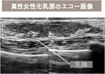 女性化乳房のエコー写真