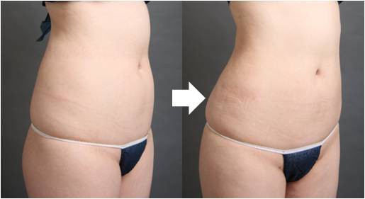 腰　太もも　ベイザー脂肪吸引　症例画像　ビフォーアフター