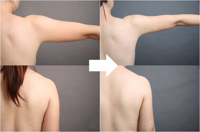 二の腕　脂肪吸引　ベイザー脂肪吸引　症例画像　ビフォーアフター