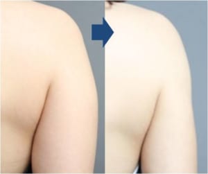 肩　脂肪吸引　症例画像　ビフォーアフター