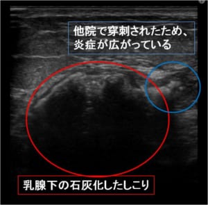 脂肪注入豊胸　しこり